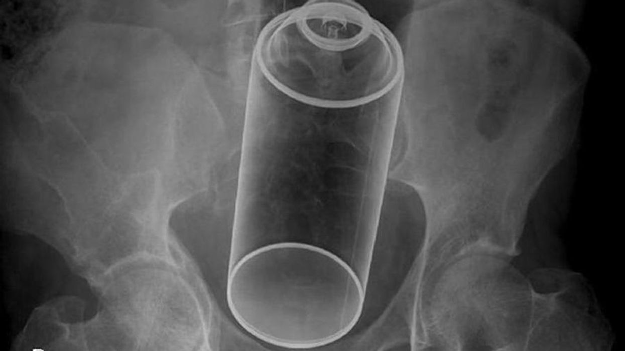 21 ordinary things people shoved up their butts